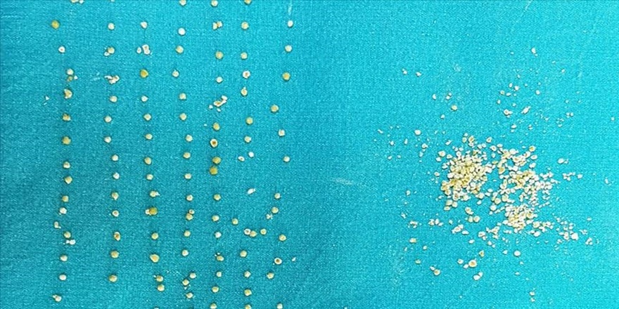 Safra kesesinden 200 taş çıkarıldı