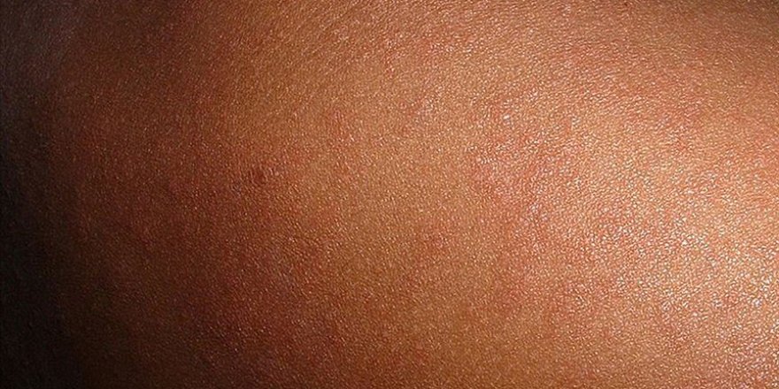 Kızamık vücuda enfeksiyonla mücadeleyi unutturuyor