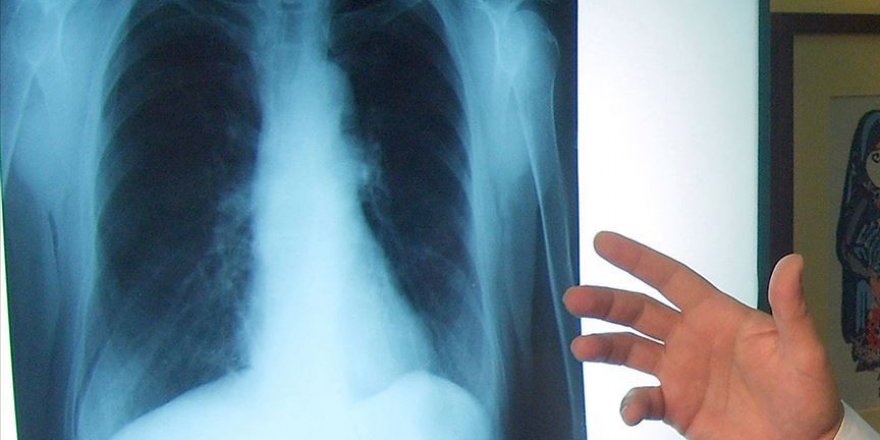 Akciğer kanserinde yeni tedavi yöntemleri sağ kalım süresini artırıyor