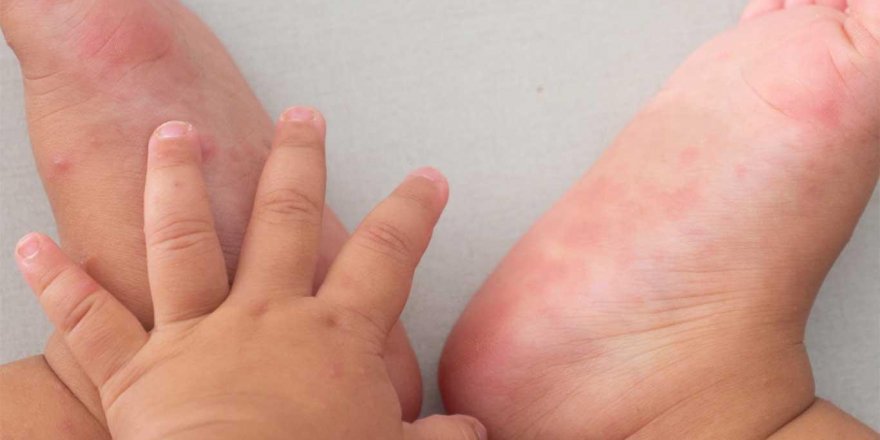 Çocuklarda el ayak ve ağız hastalığına dikkat!
