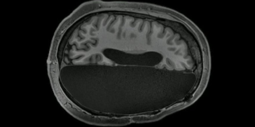 'Beyninin yarısı alınan insanlar normal yaşamını sürdürüyor'