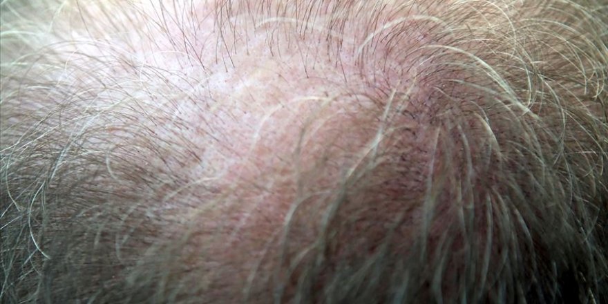 Saç dökülmesinin üç aydan uzun sürmesi hastalık habercisi