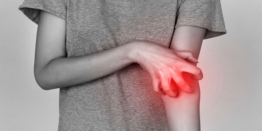 Uyuz vakalarında erken tanı çok önemli