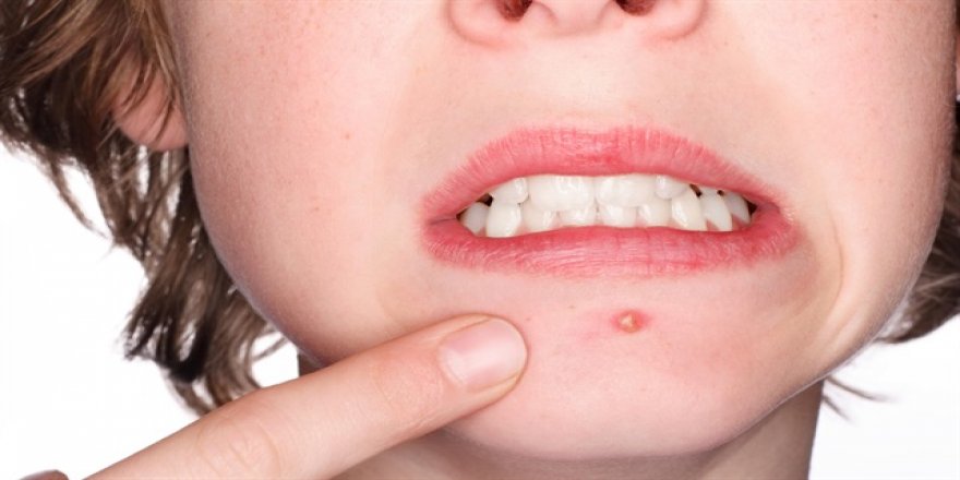 Geçmeyen sivilce kabusunuz olmasın