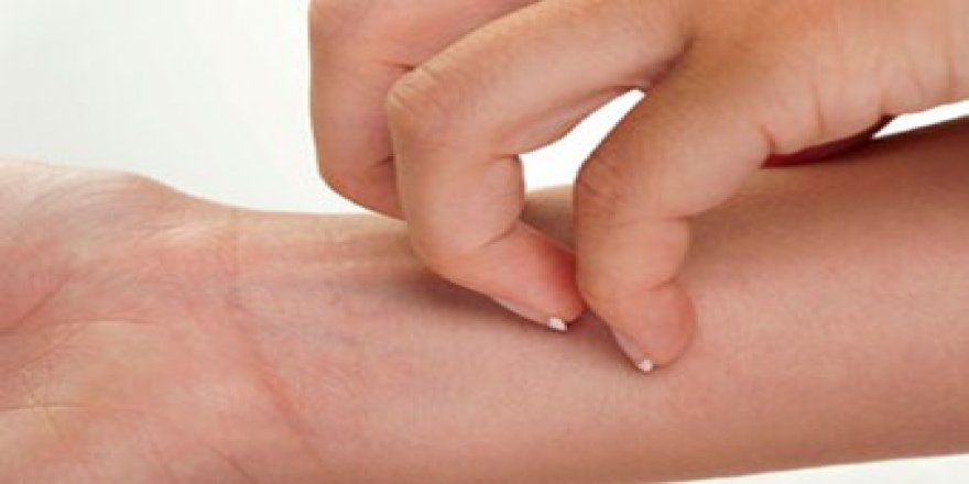 Sağlık Müdürlüğünden 'Uyuz vakası' açıklaması: Giderek yayılıyor