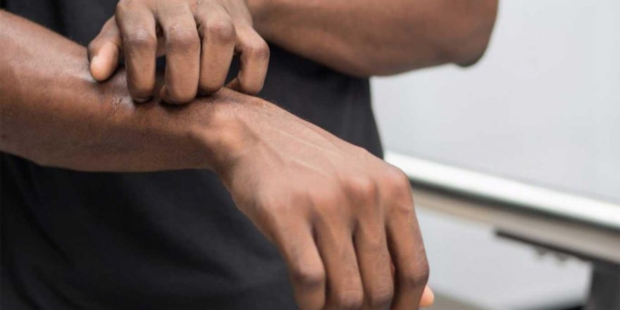 Pandemi döneminde 'uyuz' vakaları arttı