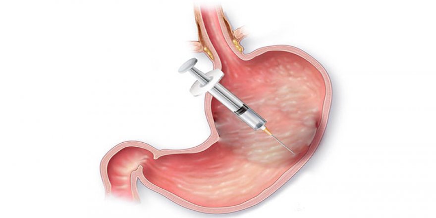 “Kilolarınızdan mide botoksu ile kurtulun”