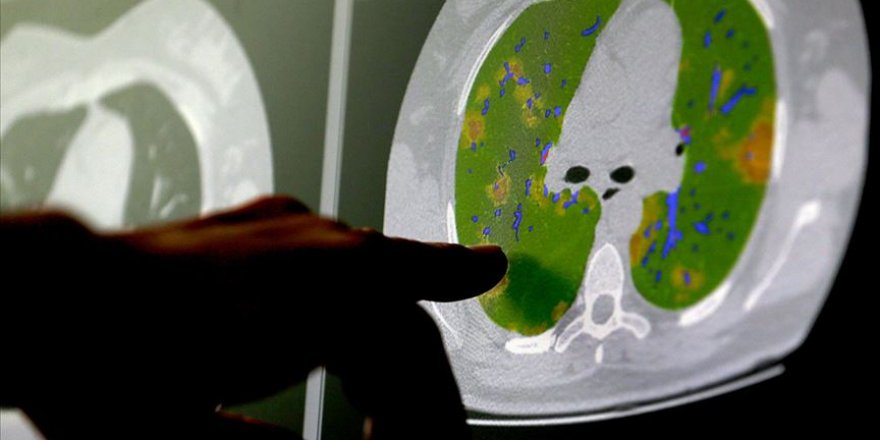 Koronavirüs siroz hastalarında çok daha ölümcül sonuçlanıyor