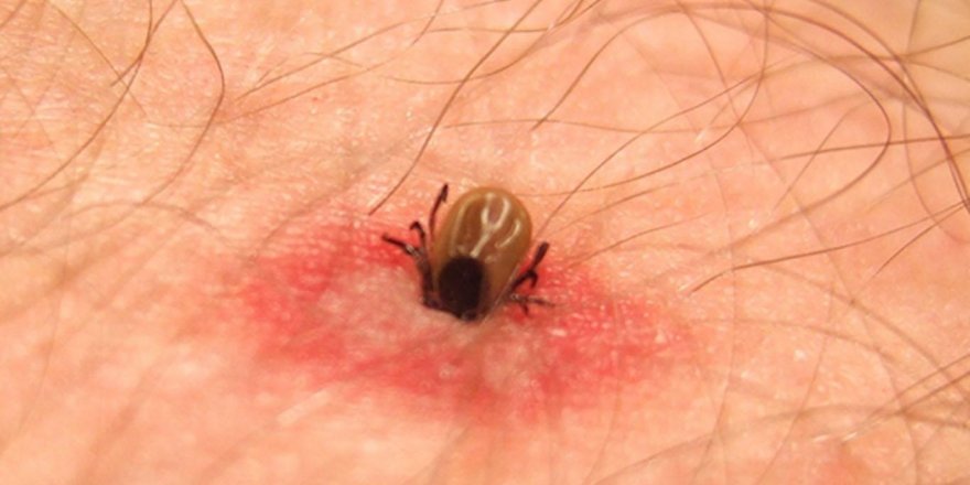 'Kene ve biti, özel solüsyon formülüyle vücudumuzdan uzak tutabiliriz'