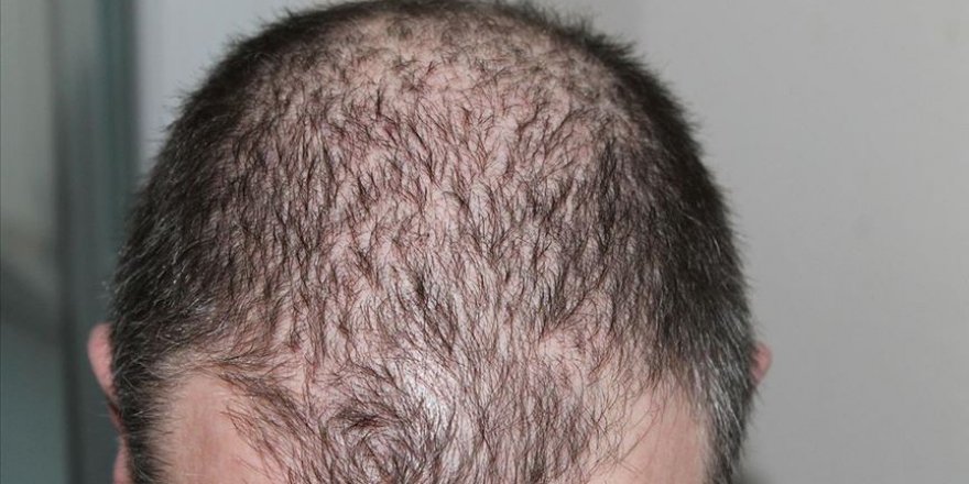 Saç ekiminde en yeni yöntem: Ozon FUE