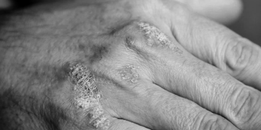 Soğuk havalarda soğuk alerjisine dikkat