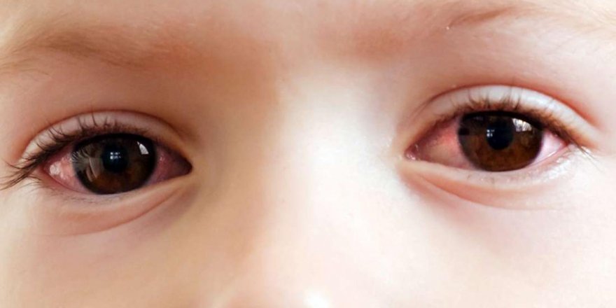 'Göz ovalamanın 5 önemli zararına dikkat'