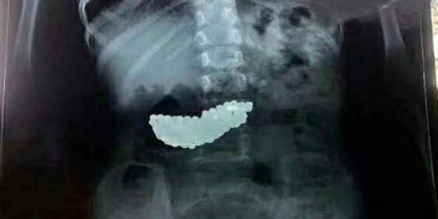 Çin'de 5 yaşındaki çocuk 190 bilyeyi 2 ay boyunca midesinde taşımış