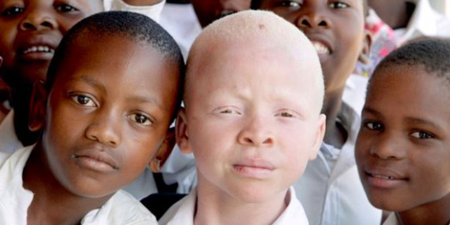 Afrika'nın batıl inanç ve cehalet mağdurları Albinolar