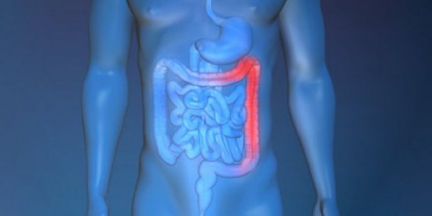 Gençlerde kalın bağırsak kanseri artıyor