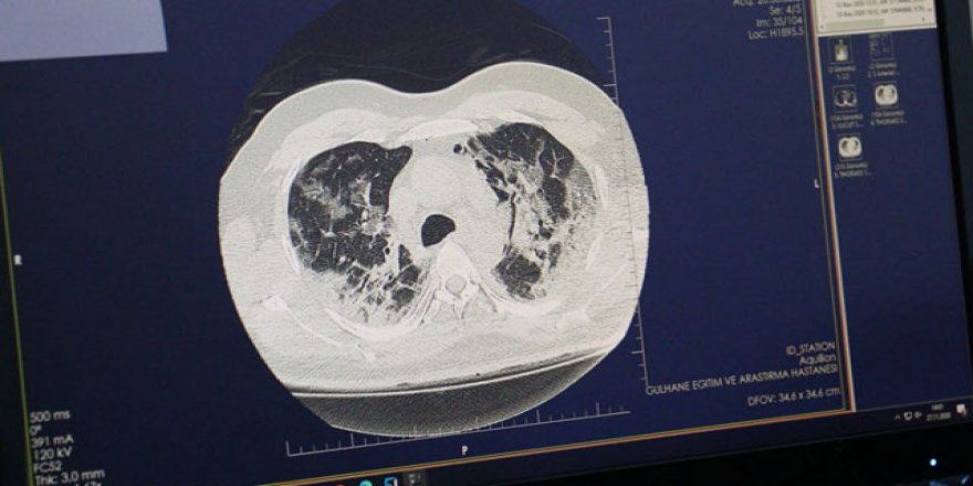 'Akciğer kanseri olan hastaların ameliyat sonrası yaşam beklentisi yüzde 85-92 arasında'