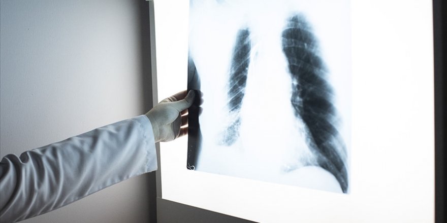 Zatürre 'spor yapan dinç kişileri de etkileyebiliyor'