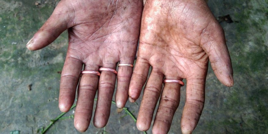 Bangladeş’te parmak izi olmayan aile görenleri şaşkına çevirdi