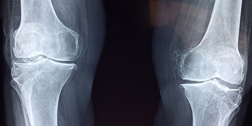 Ailesinde romatoid artrit vakası olan kişilerde hastalığın görülme riski 10 kat fazla