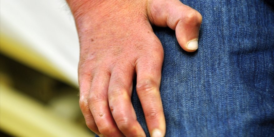 Lepranın erken teşhis ve tedavisi uzuv kayıplarını önlüyor