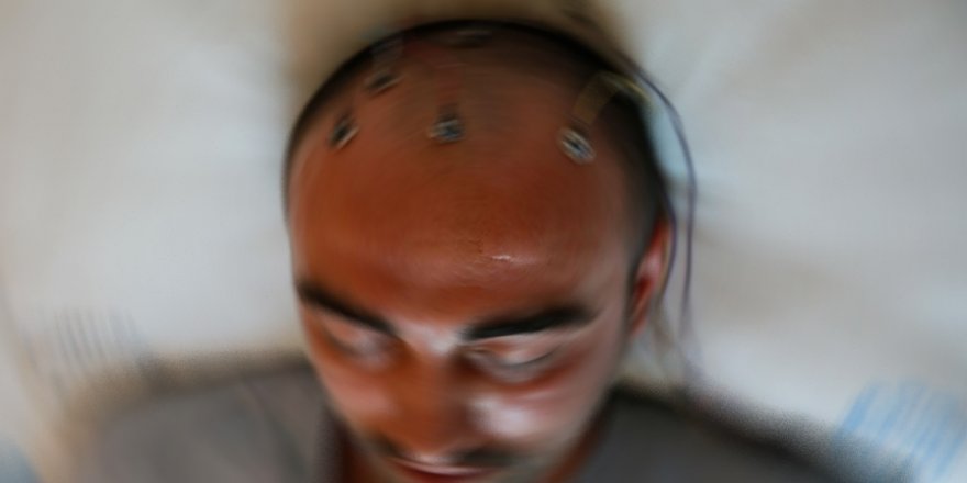 'Covid-19'a yakalananlarda epilepsi nöbeti görülüyor'