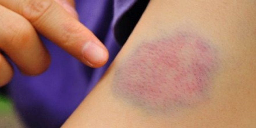 Çocuğunuzun cildinde kolay oluşan morluklara dikkat