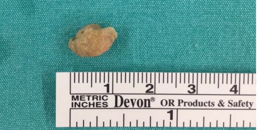 Gerçeği 10 yıl sonra öğrendi; bademcik iltihabı dediler taş çıktı