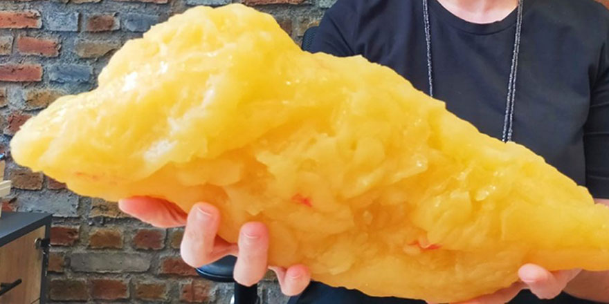 Günde 1 poğaça yiyenin vücudunda 20 günde meydana gelen yağ bu!