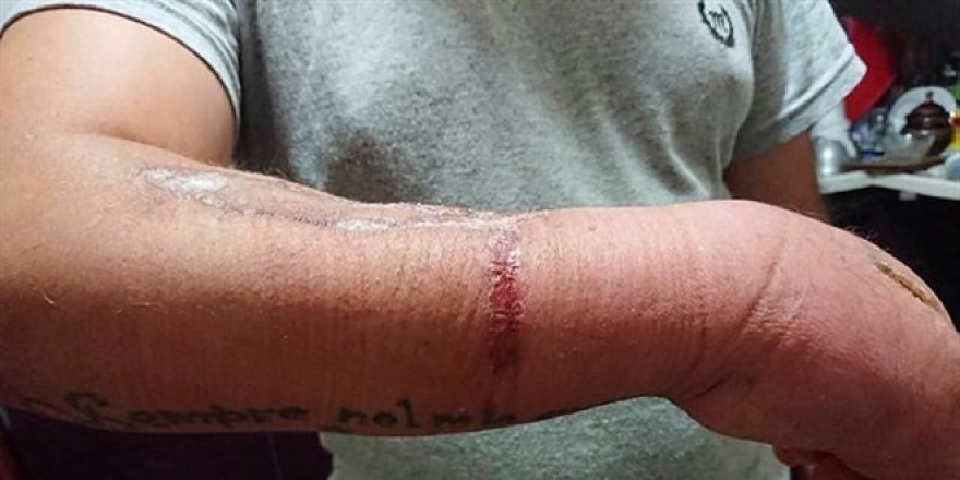 Çamaşır suyu Hacı Ali Aydar'ın hayatını kararttı