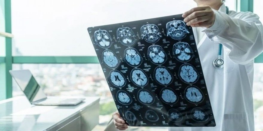 Demans ve felce karşı laboratuvarda mini beyinler üretiliyor