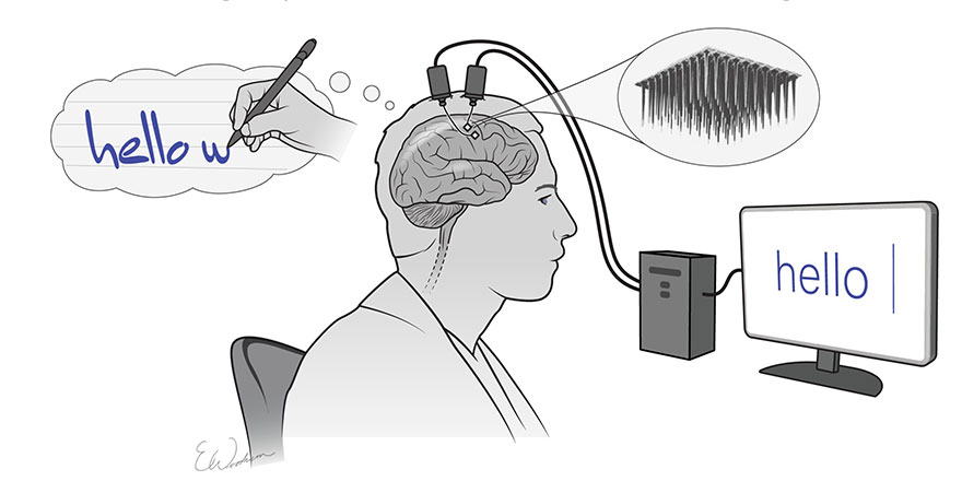 Felçli hasta beyin implantıyla düşüncelerini yazıya döktü