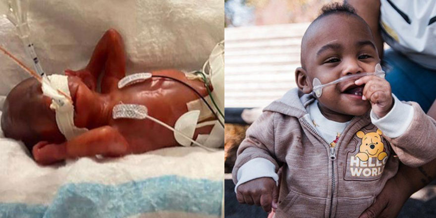 420 gram doğdu, dünyanın en prematüre bebeği oldu