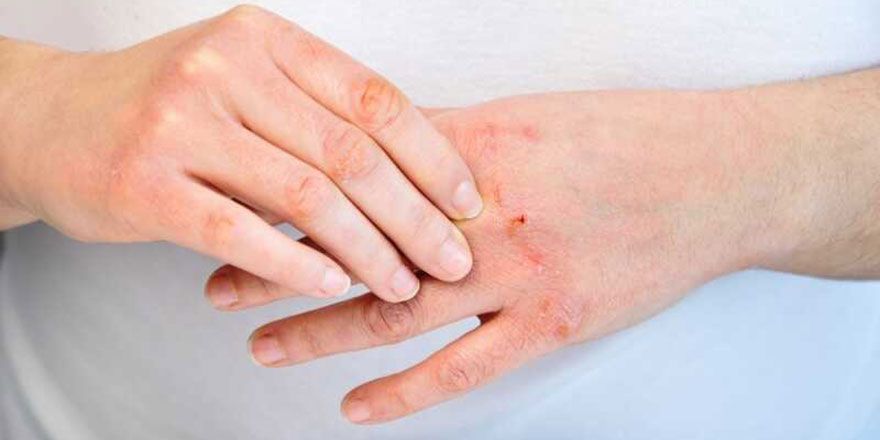 Egzaması olanlar dikkat: Dezenfektan ve kolonya hastalığı artırıyor