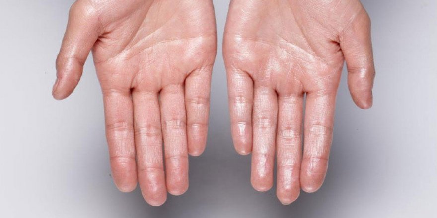 El terlemesi sorunundan 15 dakikada kurtuldu