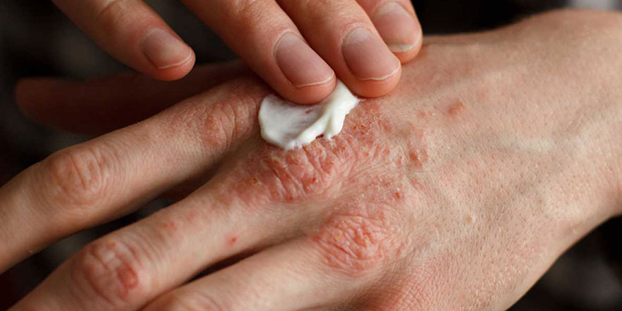 Salgında kullanılan dezenfektan ve kolonya ile egzama iki kat arttı