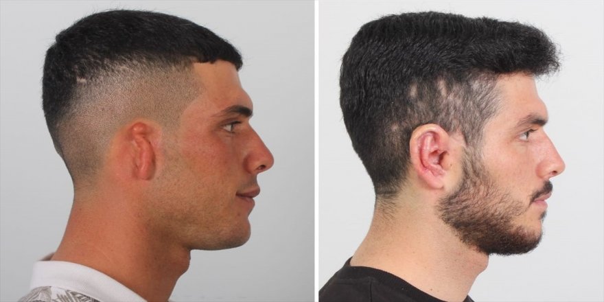 Karaman'da göğüs kafesi dokusundan kulak yapıldı