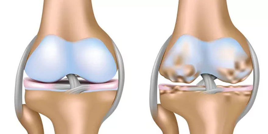 Eklemlerinizden tıkırtı ya da çıtırtı geliyorsa dikkat! İşte sebebi ve tedavisi