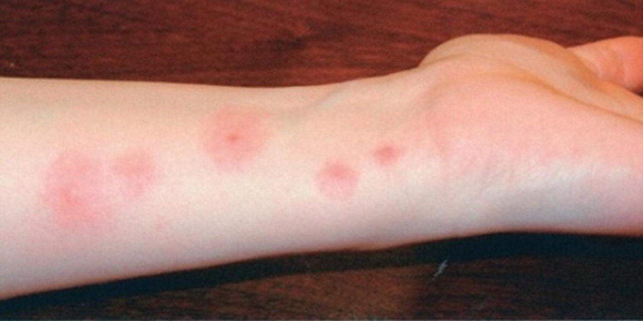 Böcek ısırıklarına karşı ne yapılmalı?