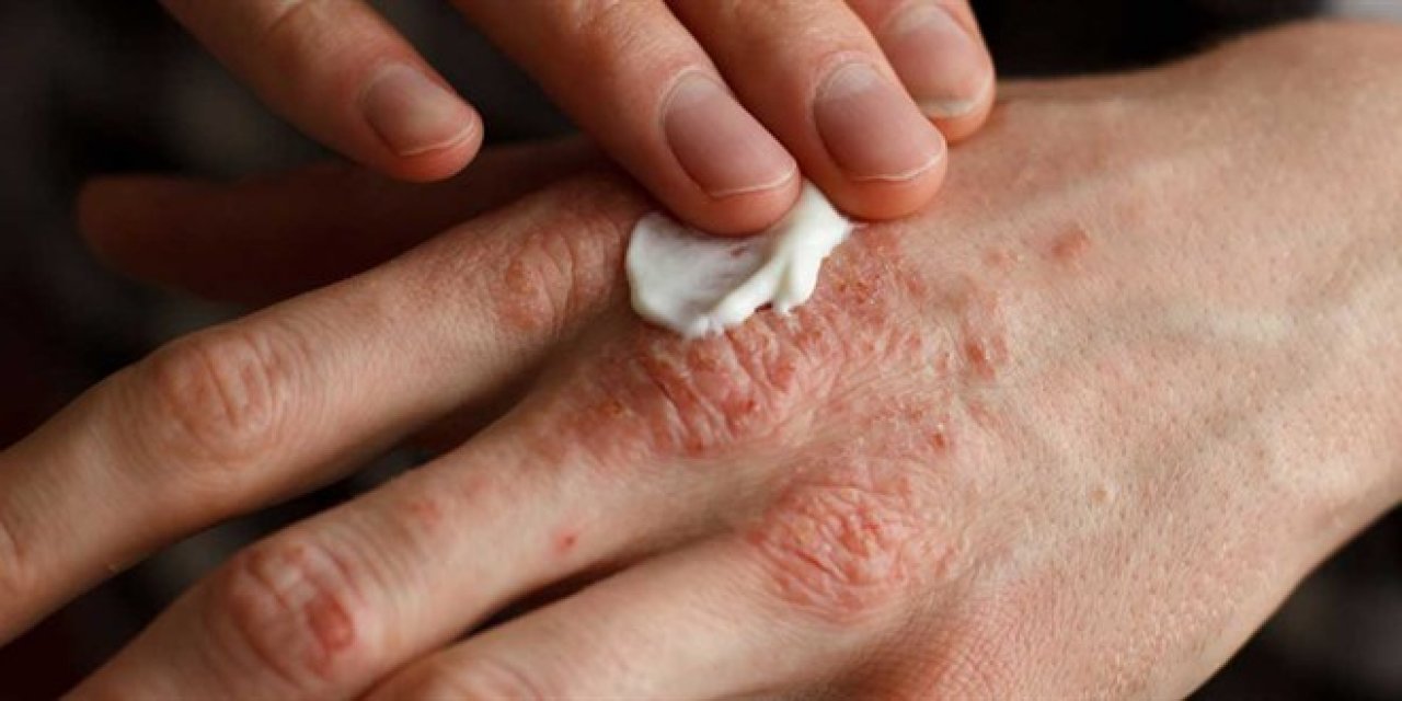 'Egzama, besin alerjisi ile bağlantılı olabilir' tespiti