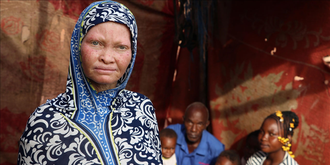 Kara kıtanın beyaz insanları 'Albinoslar'