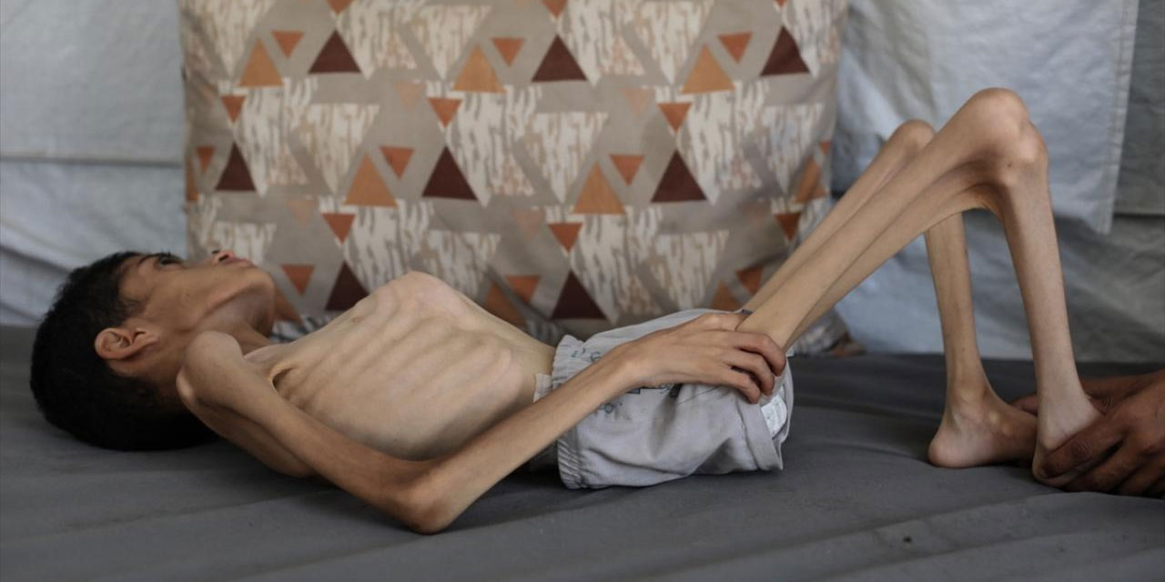Gazze'de 16 yaşındaki İbrahim'in vücut ağırlığı 7,5 kilograma düştü