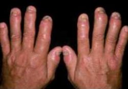 Sedef, bitki tedavisiyle iyileşir mi?