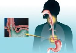 Sebebini bulamadığınız öksürük reflü olabilir