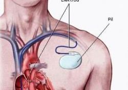 Kalp pilleri anne olmaya engel mi?