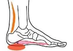 Topuk dikeni, şok dalga tedavisiyle büyük ölçüde iyileşiyor