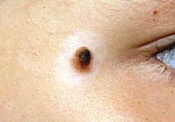 İsveçlilerde cilt kanseri artıyor