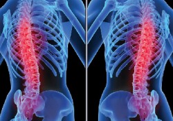 Çocukluk çağı travmaları bel fıtığına neden olabilir