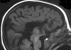 MPS hastalığıyla mücadele için dernek kuruldu