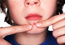 Gençlerin mutsuzluk sebebi: Sivilce-akne