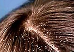 Saç dökülmesine deva bitki